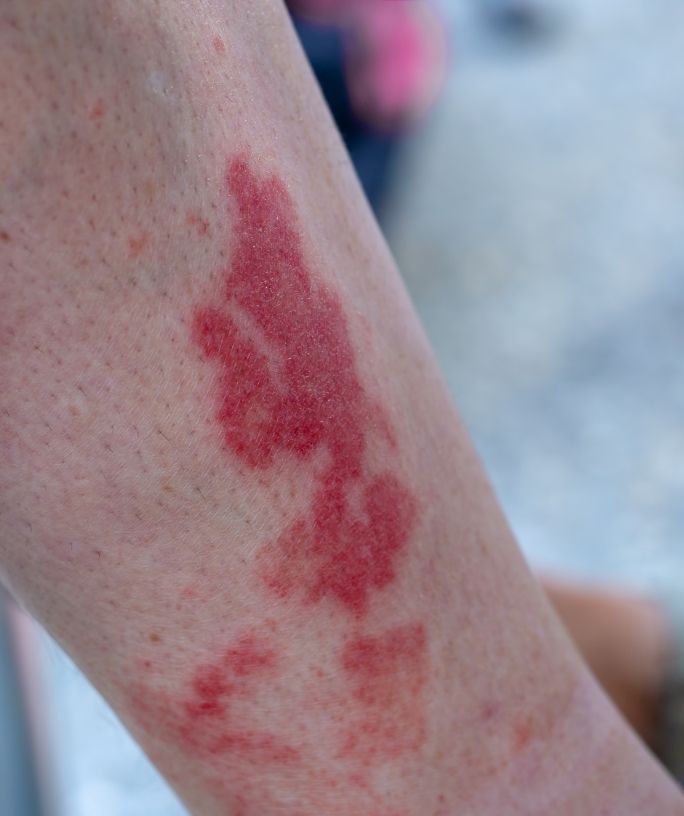 close-up view of golfer's vasculitis, or the Disney Rash, on a woman's leg
