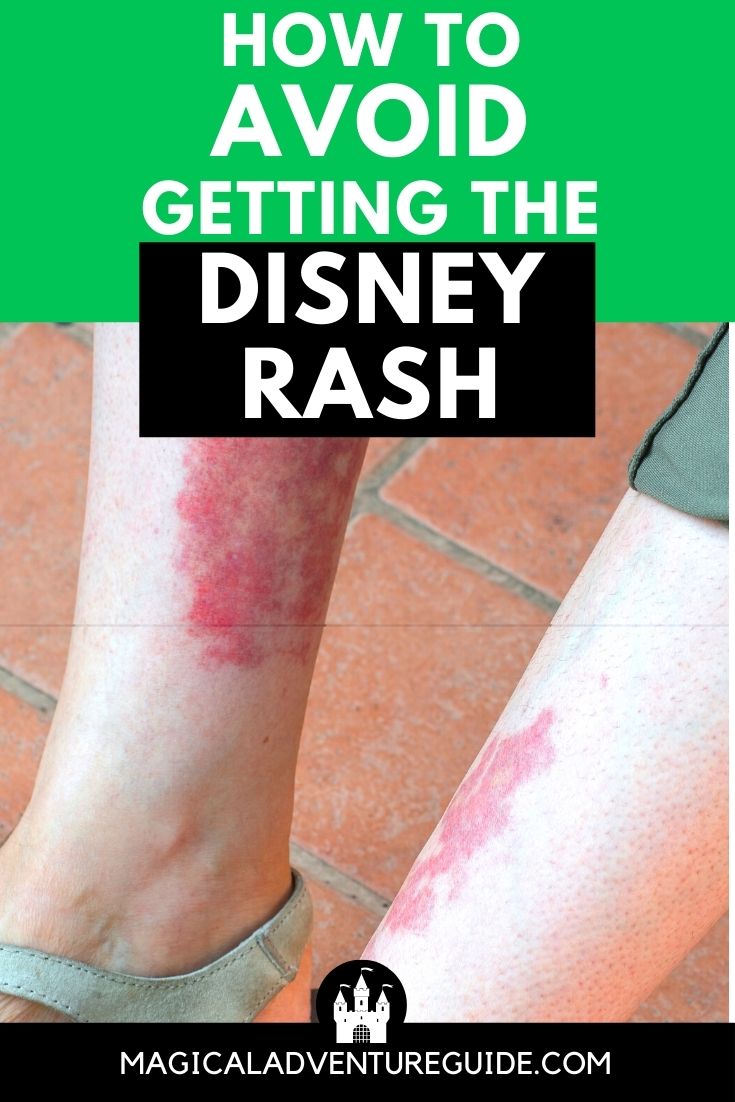 view of two legs with the Disney rash on the medial surfaces of the lower legs. An overlay reads, "How to Avoid Getting the Disney Rash"