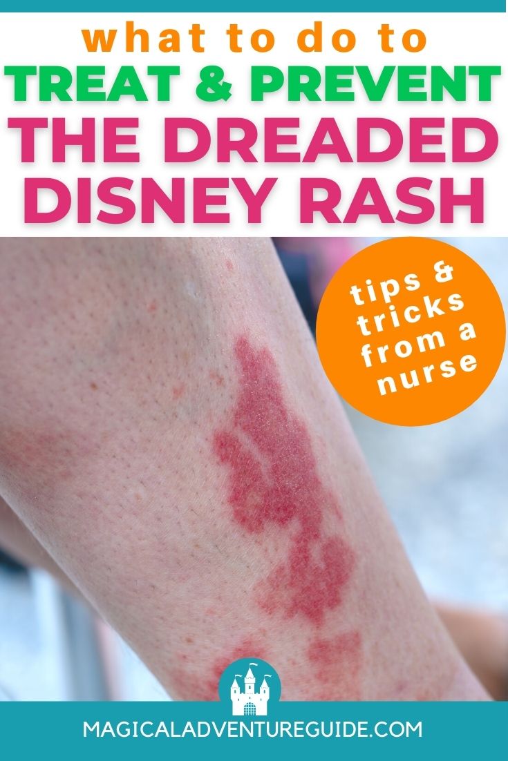 close-up view of the Disney Rash, also known as exercise-induced vasculitis. An overlay reads, "what to do to treat and prevent the dreaded disney rash: tips and tricks from a nurse"